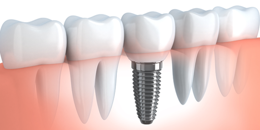 dental implants img 1.png