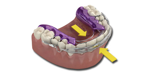 inman aligner braces page image 1.png