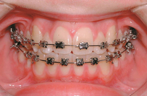 metal braces .jpg