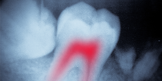 root canal img 2.png
