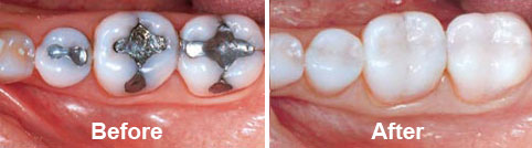 white-fillings-before-after.jpg